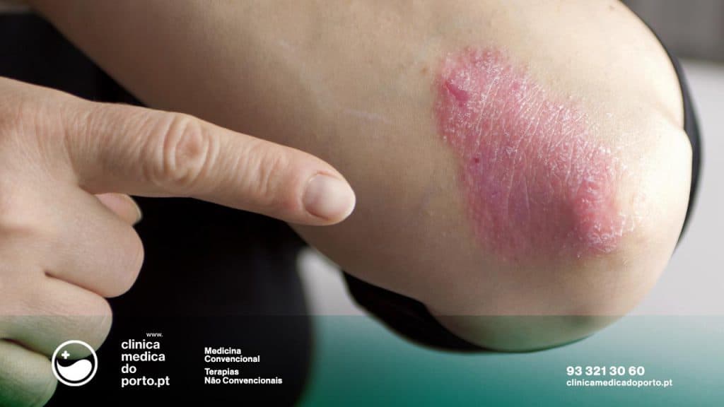 Psoríase - Homoepatia na Hepatite - Excessos Alimentares - Clinica Medica do Porto