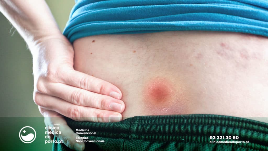 quisto-sacrococcigeo-clinica-medica-do-porto