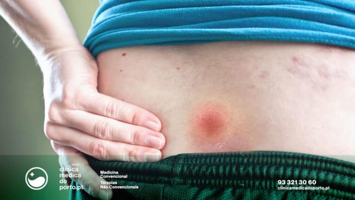 quisto-sacrococcigeo-clinica-medica-do-porto