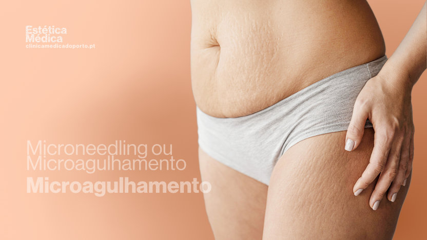 Uma mulher posa em cuecas, com as mãos na cintura, a transpirar confiança e a abraçar o corpo com estrias.